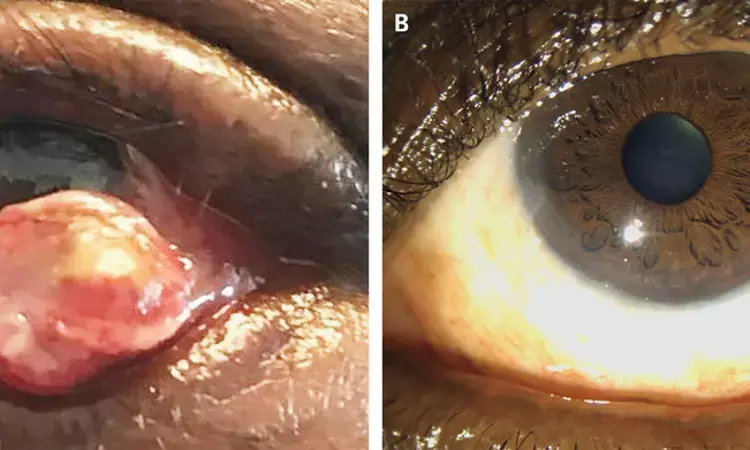 Case of conjunctival Kaposis Sarcoma reported in NEJM
