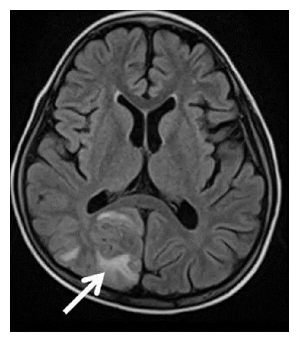 Rare case of cerebral infarction in Congenital Adrenal Hyperplasia: A report
