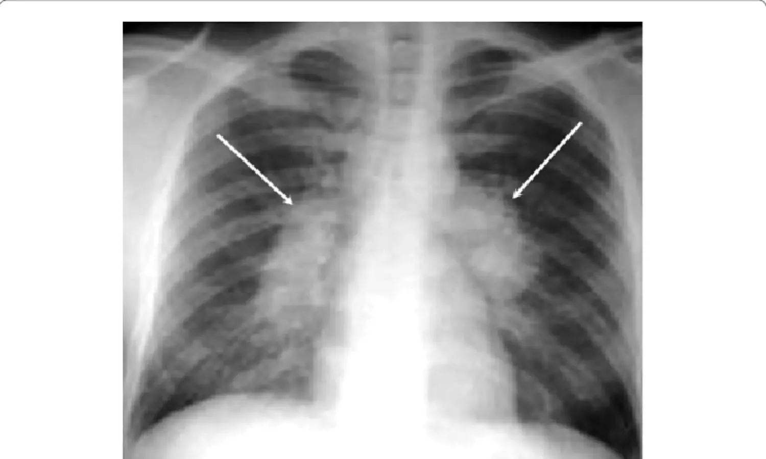Two views better than one in chest X-ray AI for classifying adenopathy: Study
