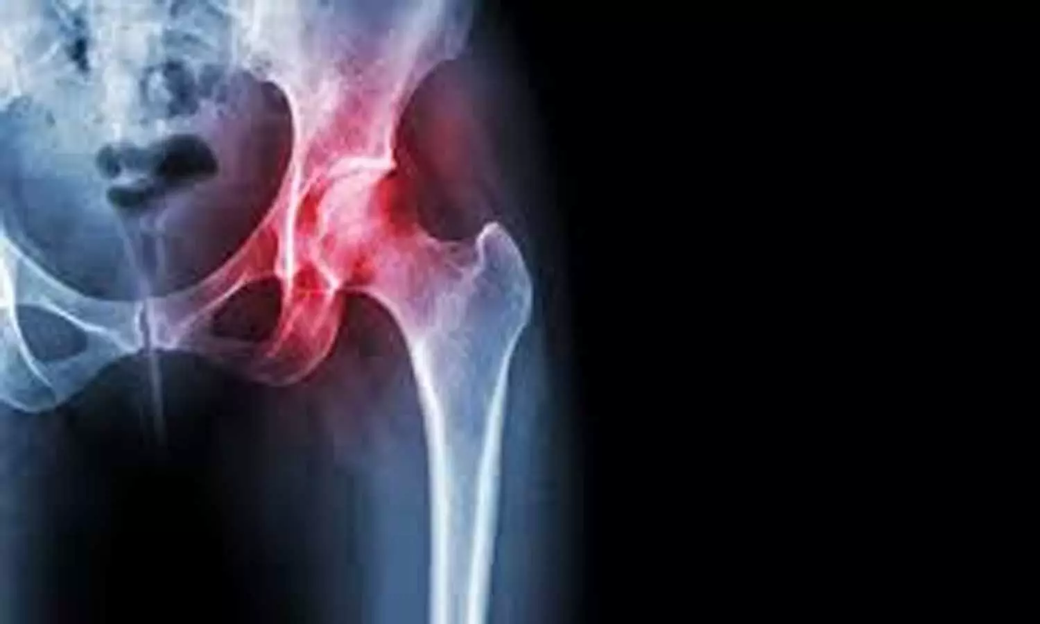 Corticosteroid injections of hip linked to rapidly destructive hip disease