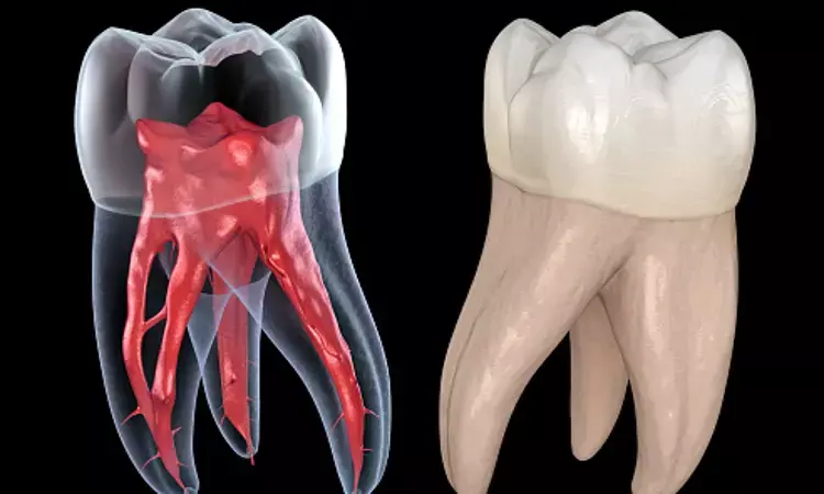 A new approach makes it easier for AI to spot pulp cavities: Study
