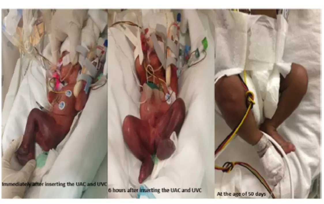 A rare case of bilateral lower limb gangrene in a neonate : Case report