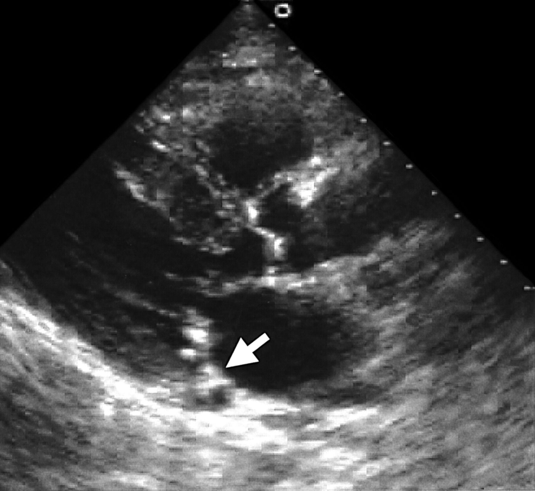 Necrotic Mitral Annular Calcification a potential source of embolism ...