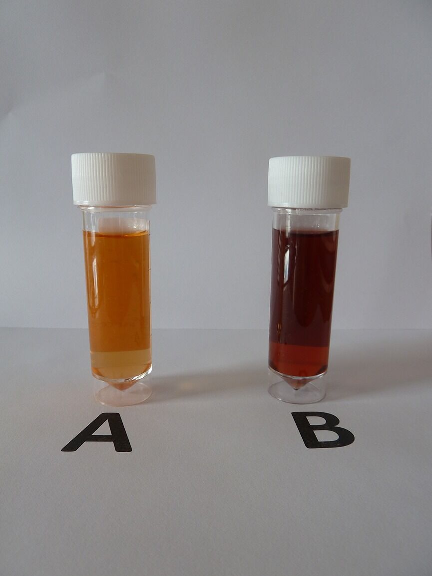 Rare Case of Acute Intermittent Porphyria Presents As Posterior ...