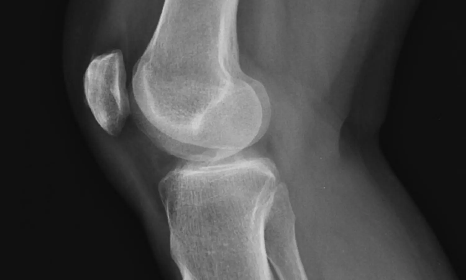 Single Lorecivivint Injection may improve function and pain control in knee osteoarthritis