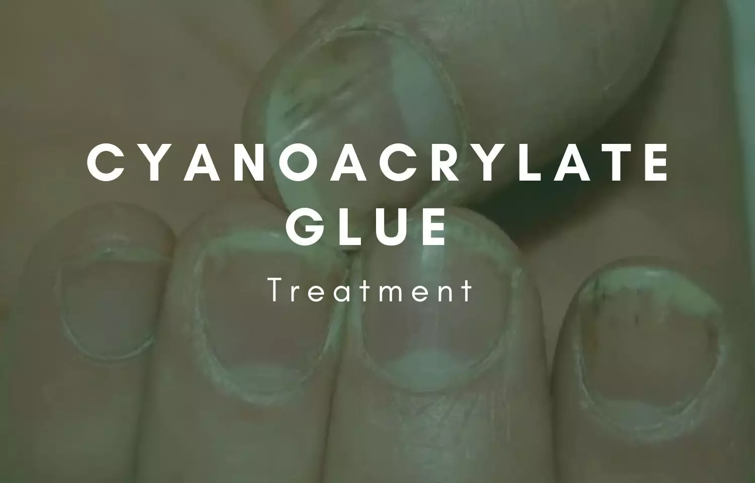 Cyanoacrylate glue - an innovative treatment for ingrown fingernail