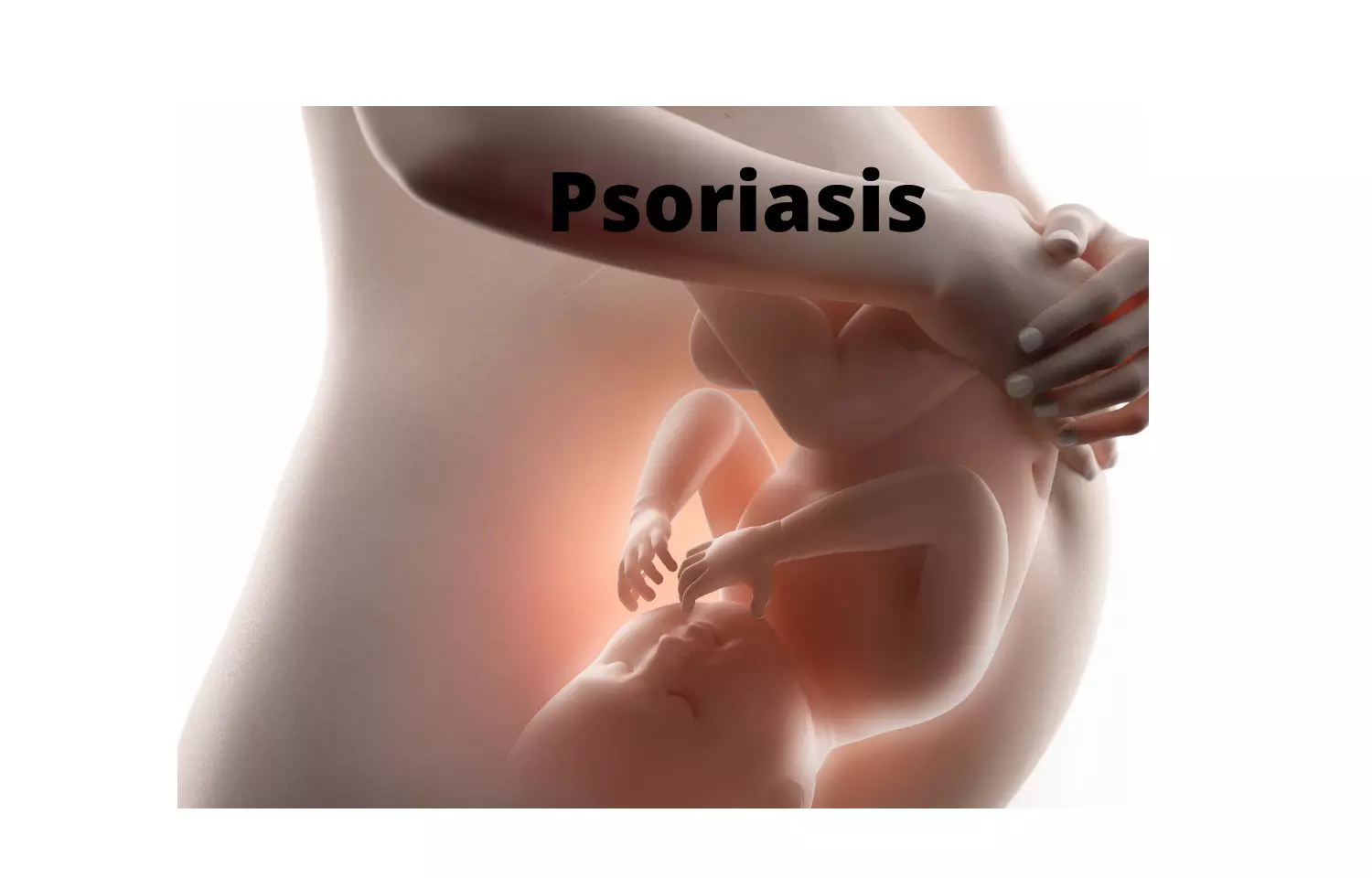 Psoriasis and PsA in pregnancy have adverse maternal events but no neonatal events: Study