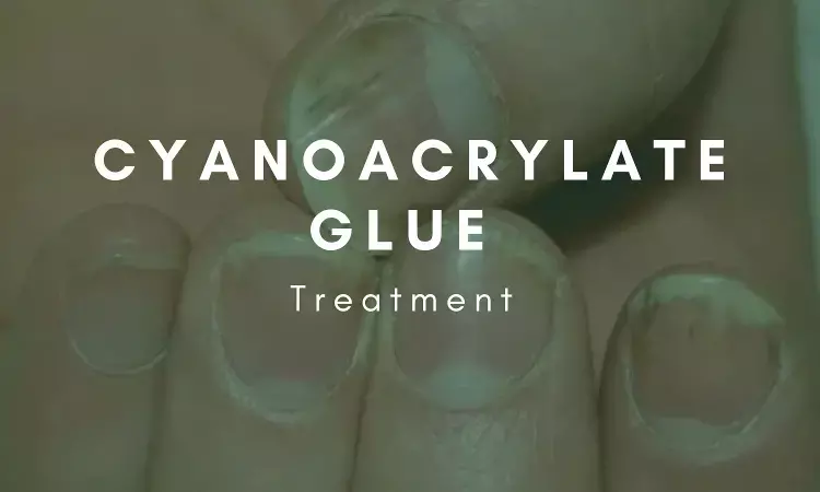Cyanoacrylate glue - an innovative treatment for ingrown fingernail