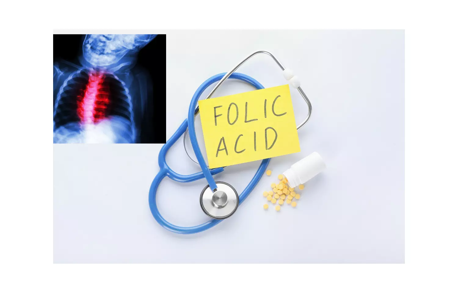Folic acid supplements during preconception reduce congenital heart defects in offsprings: Study