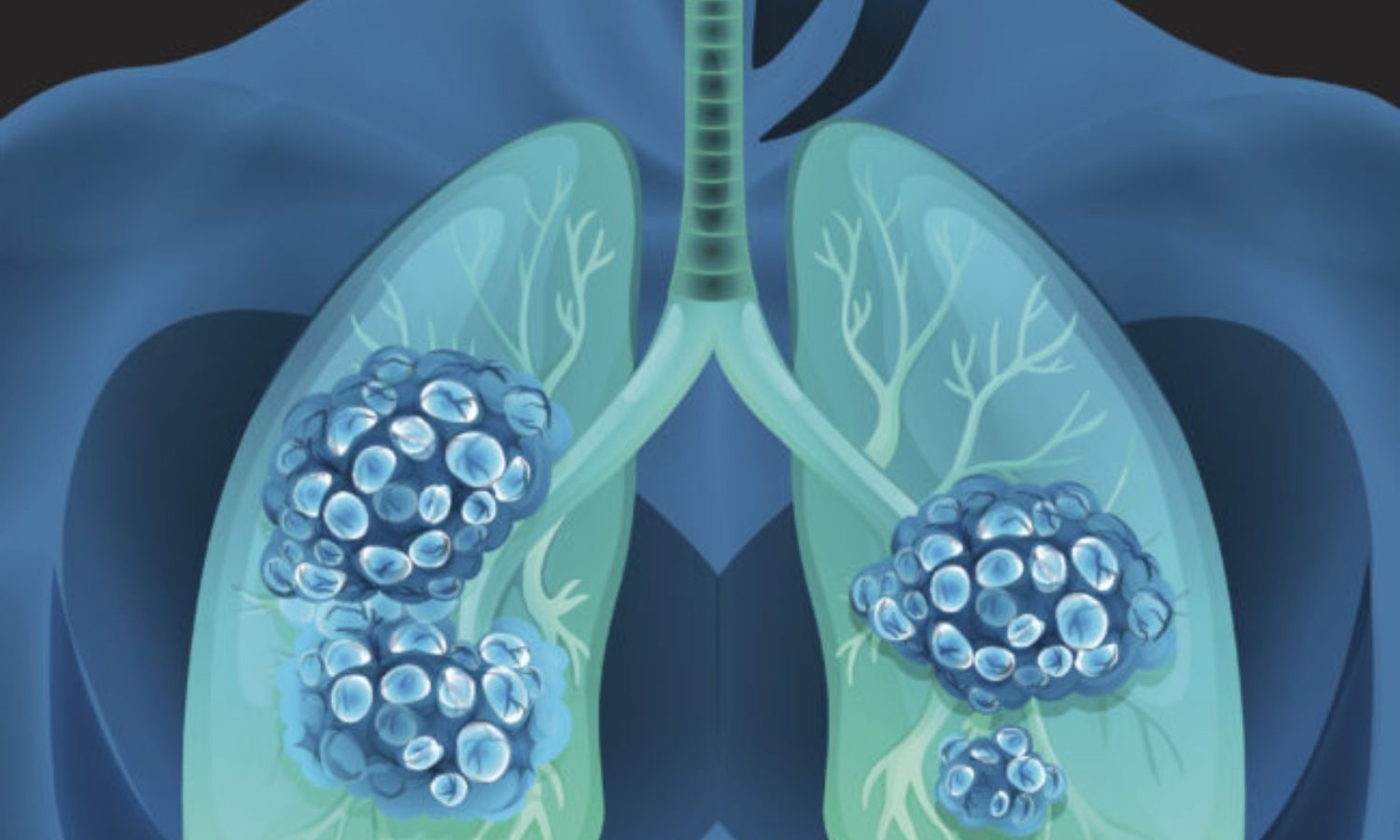 Biopsy of peripheral lung nodules enhanced by 3D image guidance: Study