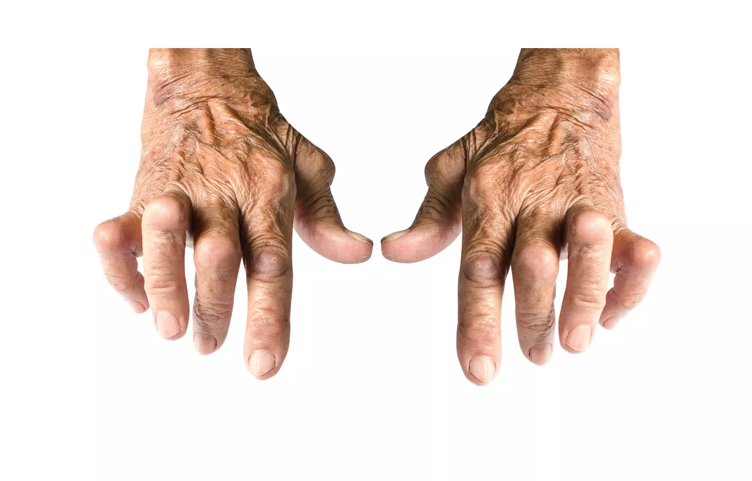 Exercise reduces sarcopenia in rheumatoid arthritis patients, reveals study
