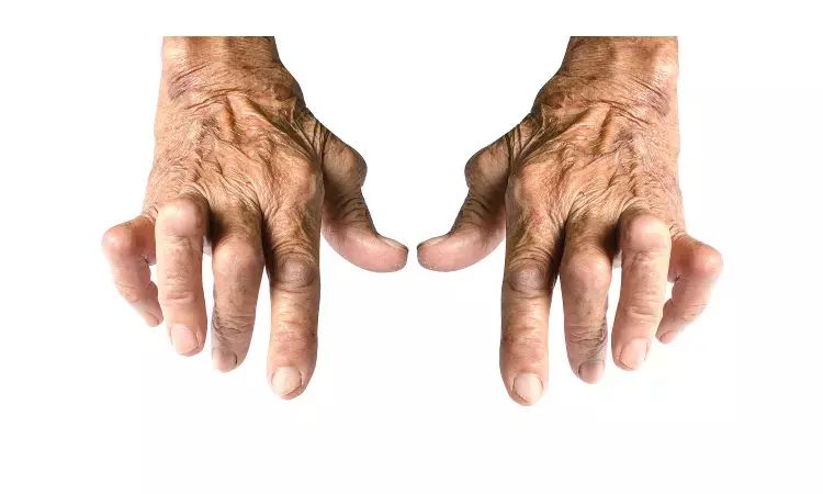 Exercise reduces sarcopenia in rheumatoid arthritis patients, reveals study
