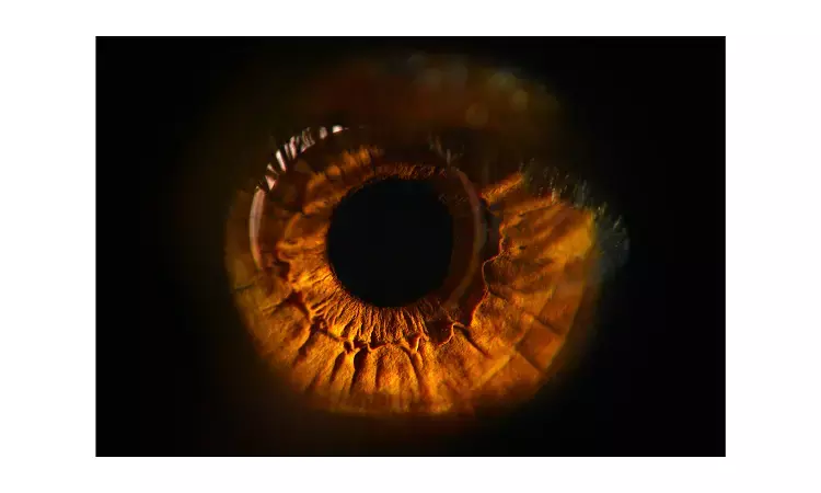 Intravitreal injections of dexamethasone implant not associated with ocular hypertension: Study