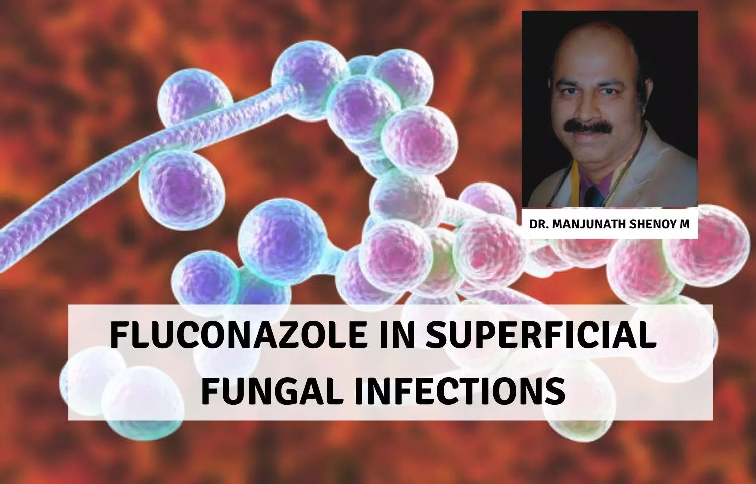 Role of Fluconazole in Superficial Fungal Infections