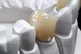 Saliva critically Influences  Mechanical Properties of Advanced Composites for dental restorations: Study
