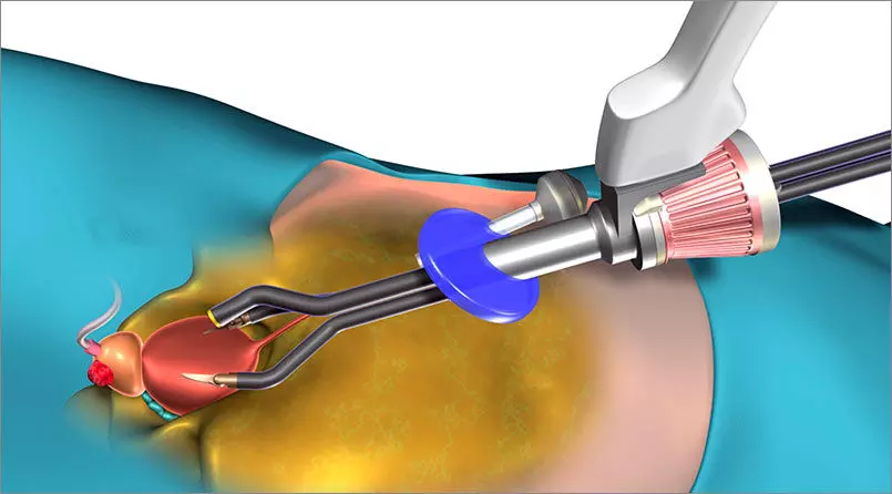 Robotic Radical Prostatectomy superior to open surgery for Localised prostate cancer: Study