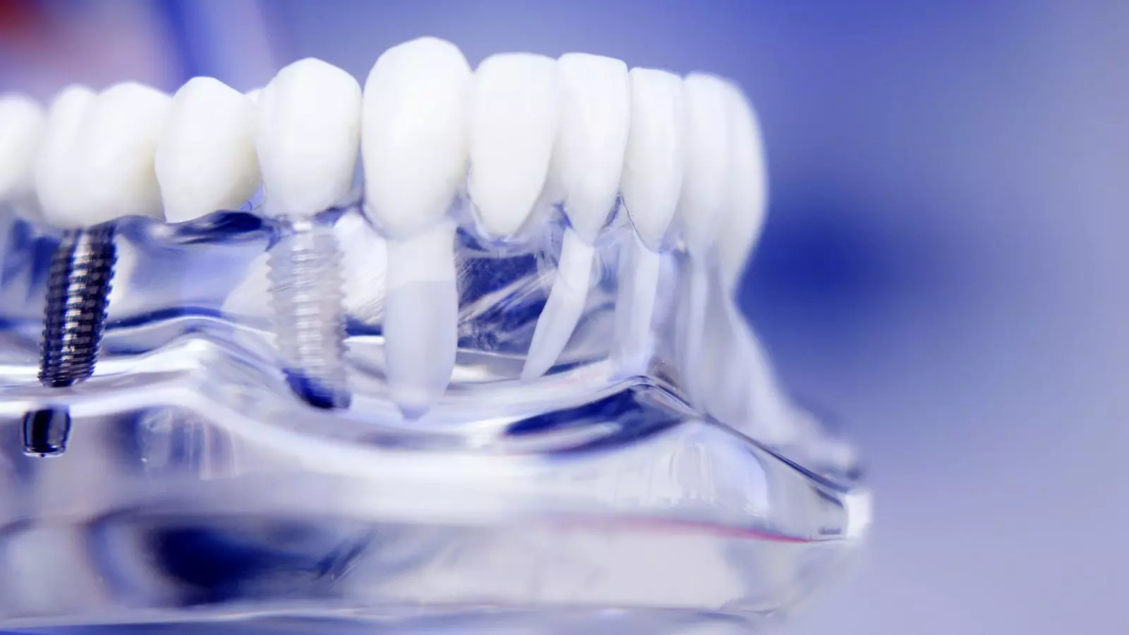 Short-term use of analgesics sufficient after dental implant surgery: Study