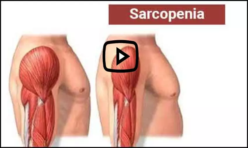 Sarcopenia decreases with exercise in RA patients