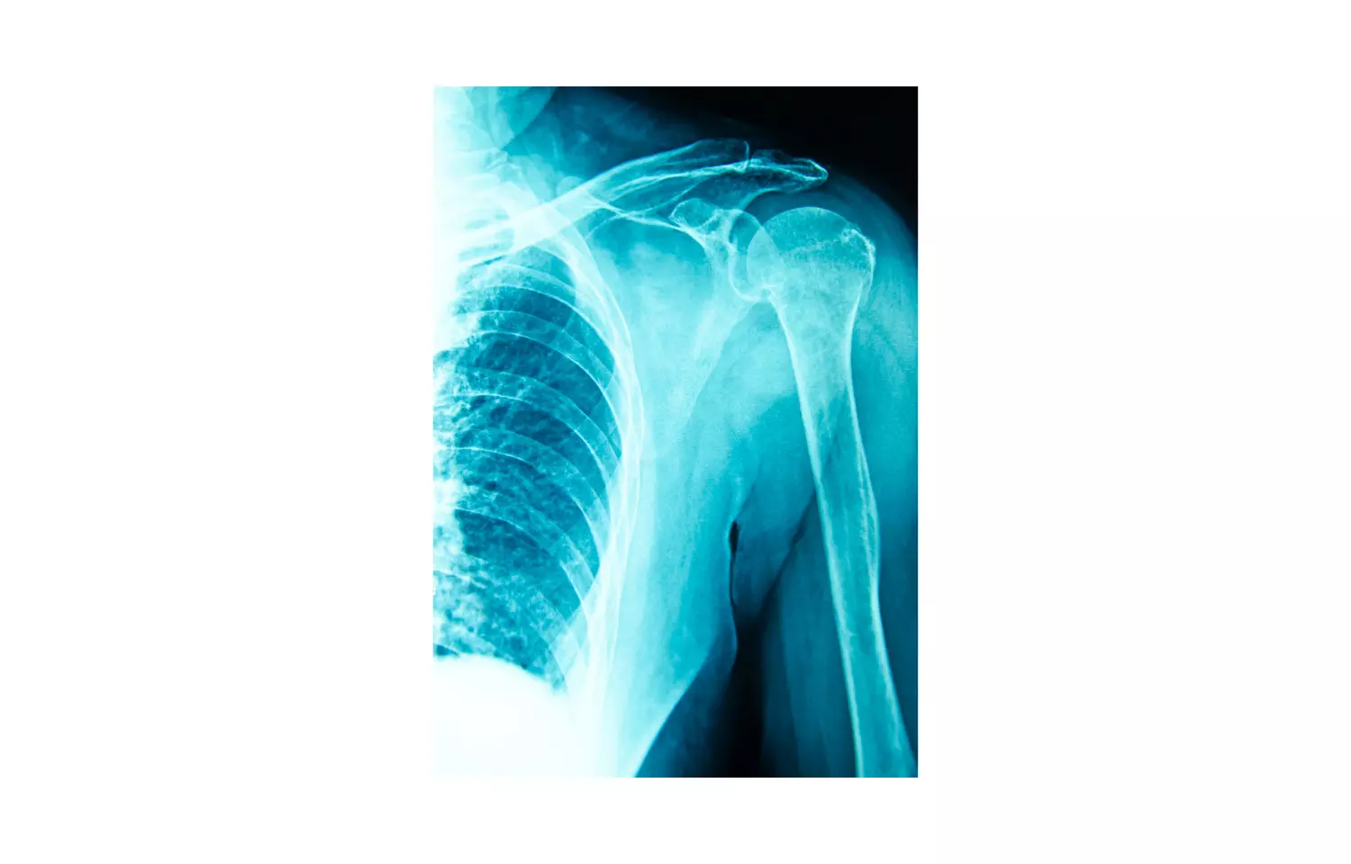 Subacromial decompression no better than other therapies for return to work in shoulder impingement