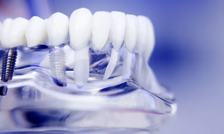 Short-term use of analgesics sufficient after dental implant surgery: Study