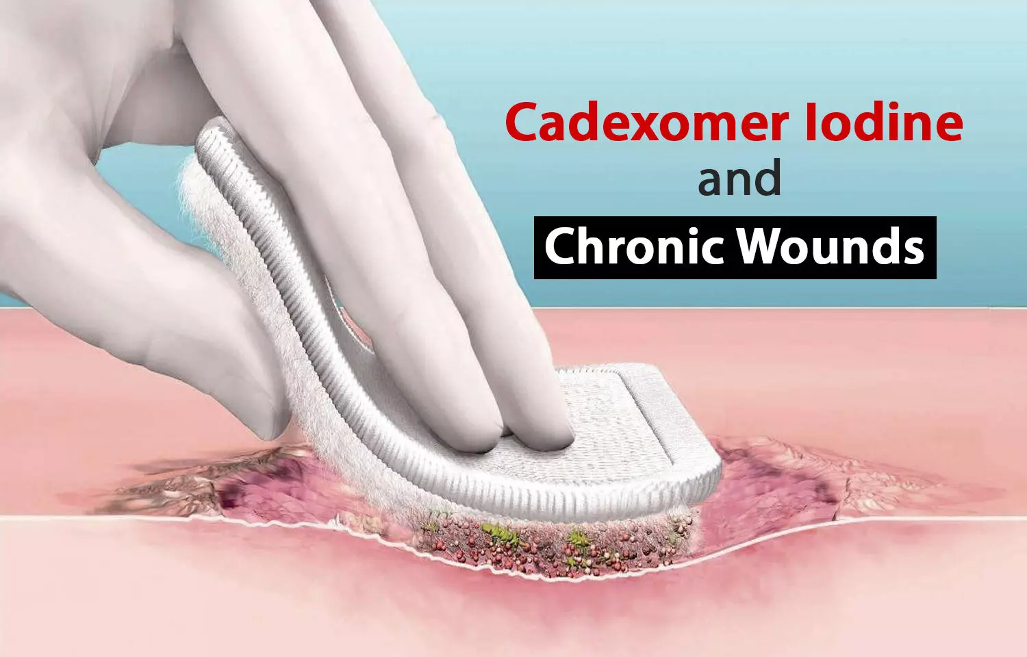 Efficacy of Cadexomer Iodine in managing chronic wounds: Reports from a meta-analysis.