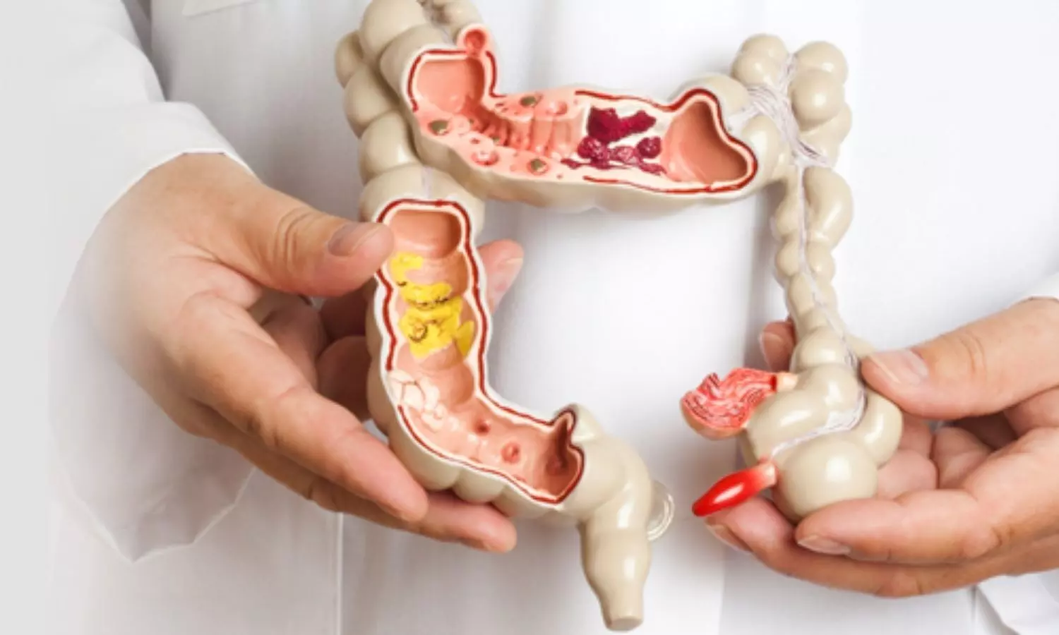 Oral plus IV antibiotic reduces SSIs by more than 50 pc in patients undergoing colorectal surgery: JAMA