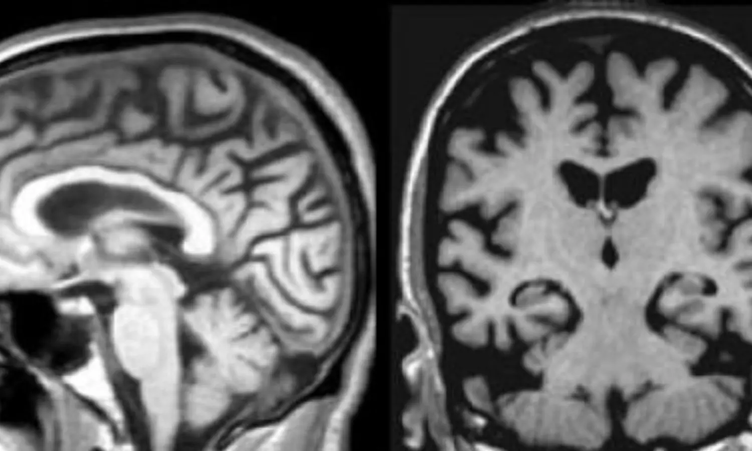 Baseline MRI atrophy may predict 2-year cognitive outcomes in early-onset Alzheimers disease: Study