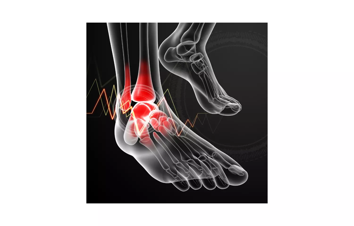 Platelet rich plasma not effective method to treat ankle arthritis: Study