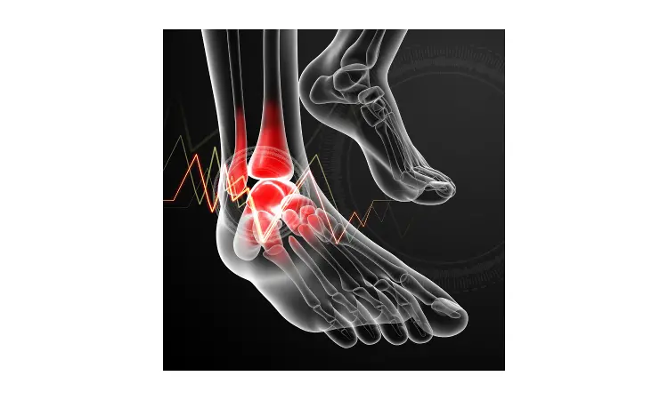 Platelet rich plasma not effective method to treat ankle arthritis: Study