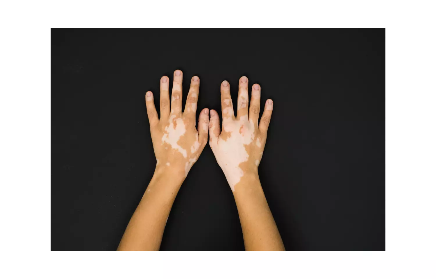 intralesional steroid injection with UV light effective option for treating vitiligo: Study