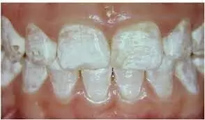 Microabrasion effective for aesthetic management of stained dental fluorosis: study
