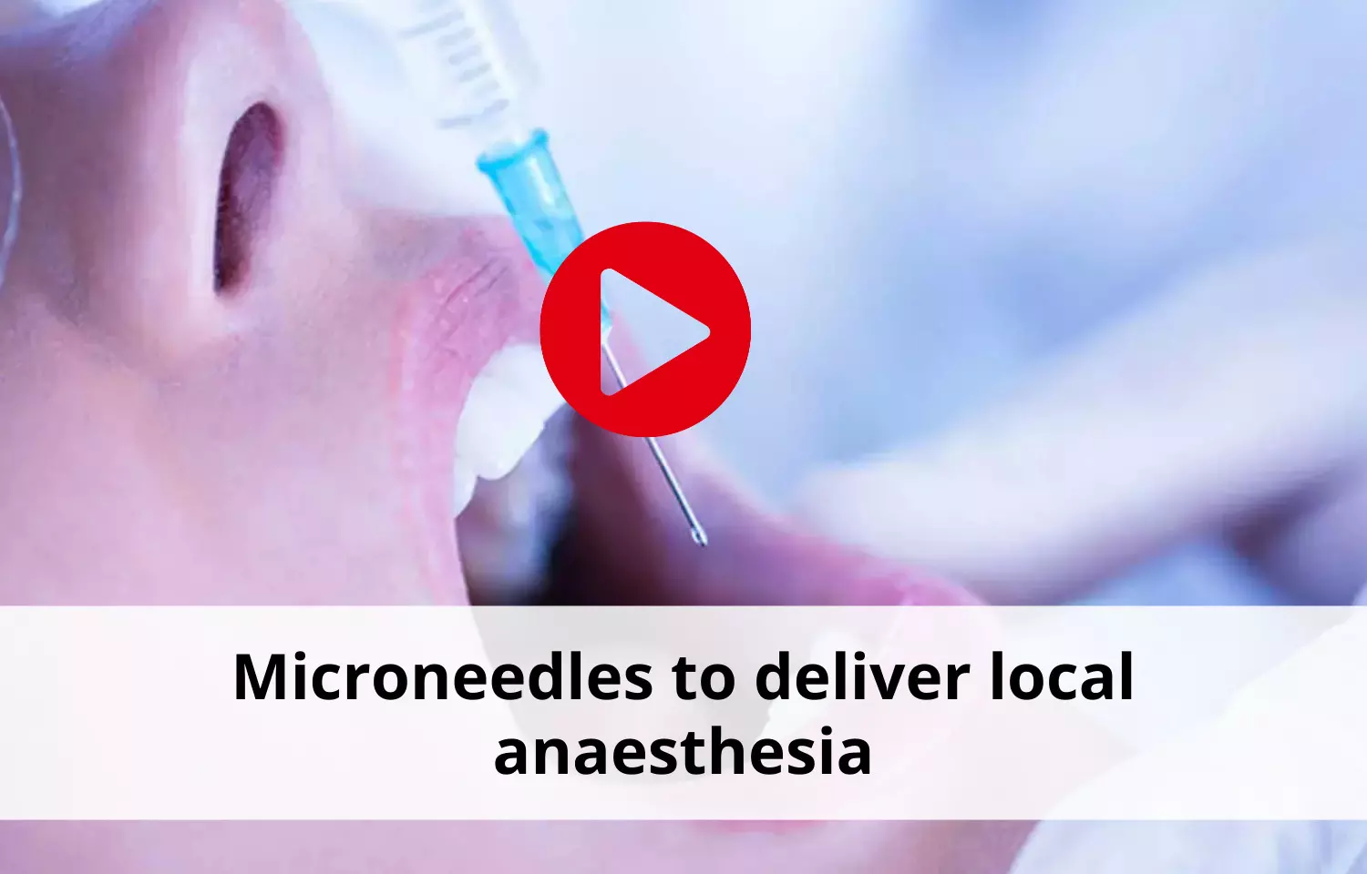Microneedles to deliver local anaesthesia