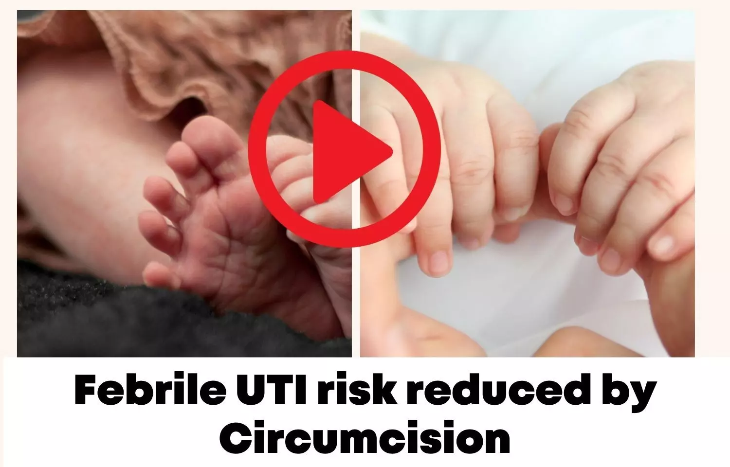 Febrile UTI risk reduced by circumcision