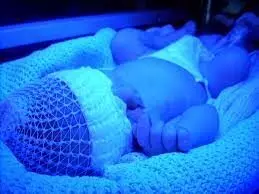 Phototherapy for neonatal hyperbilirubinemia not associated with childhood cancer: Study