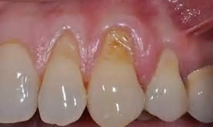 Enamel matrix derivative use seems promising in implant dentistry: Study