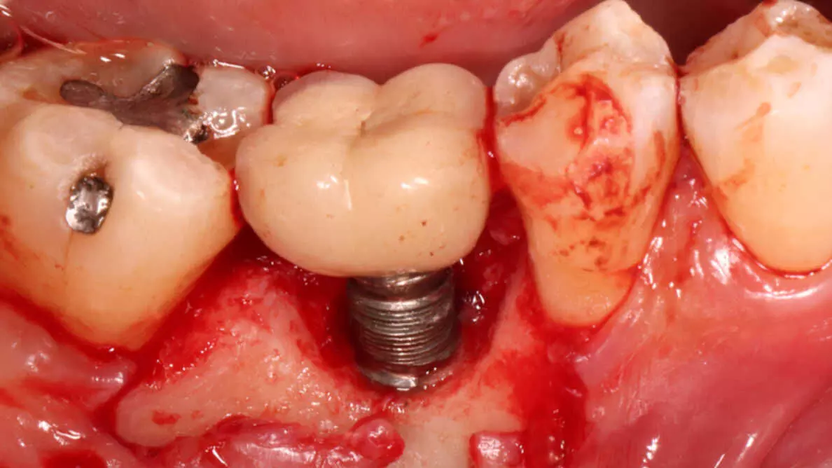 Peri-implantitis leading cause for implant removal finds study
