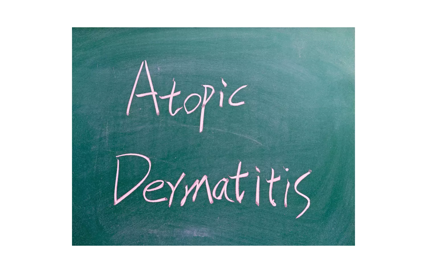 Tralokinumab plus topical corticosteroids effective in severe atopic dermatitis
