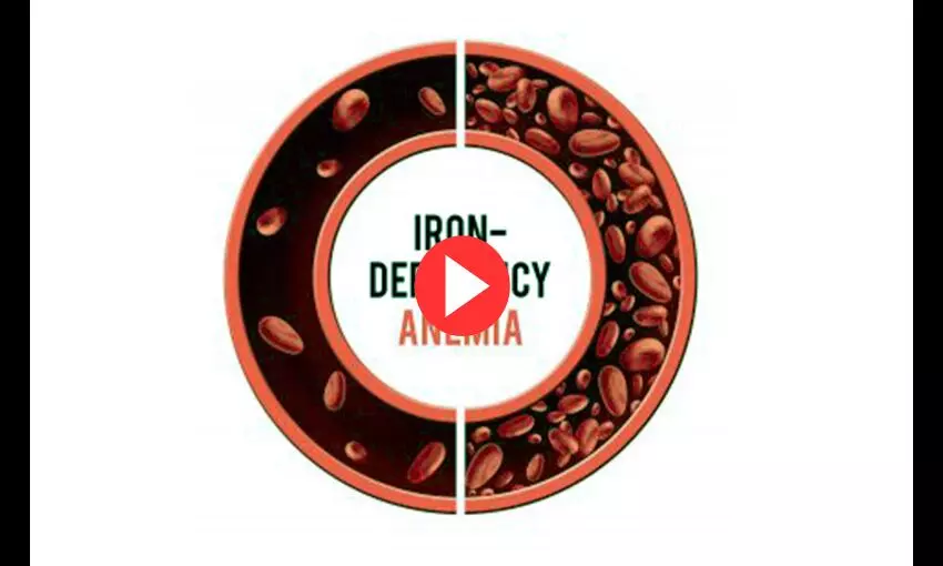 Iron deficiency anemia – All you need to know!