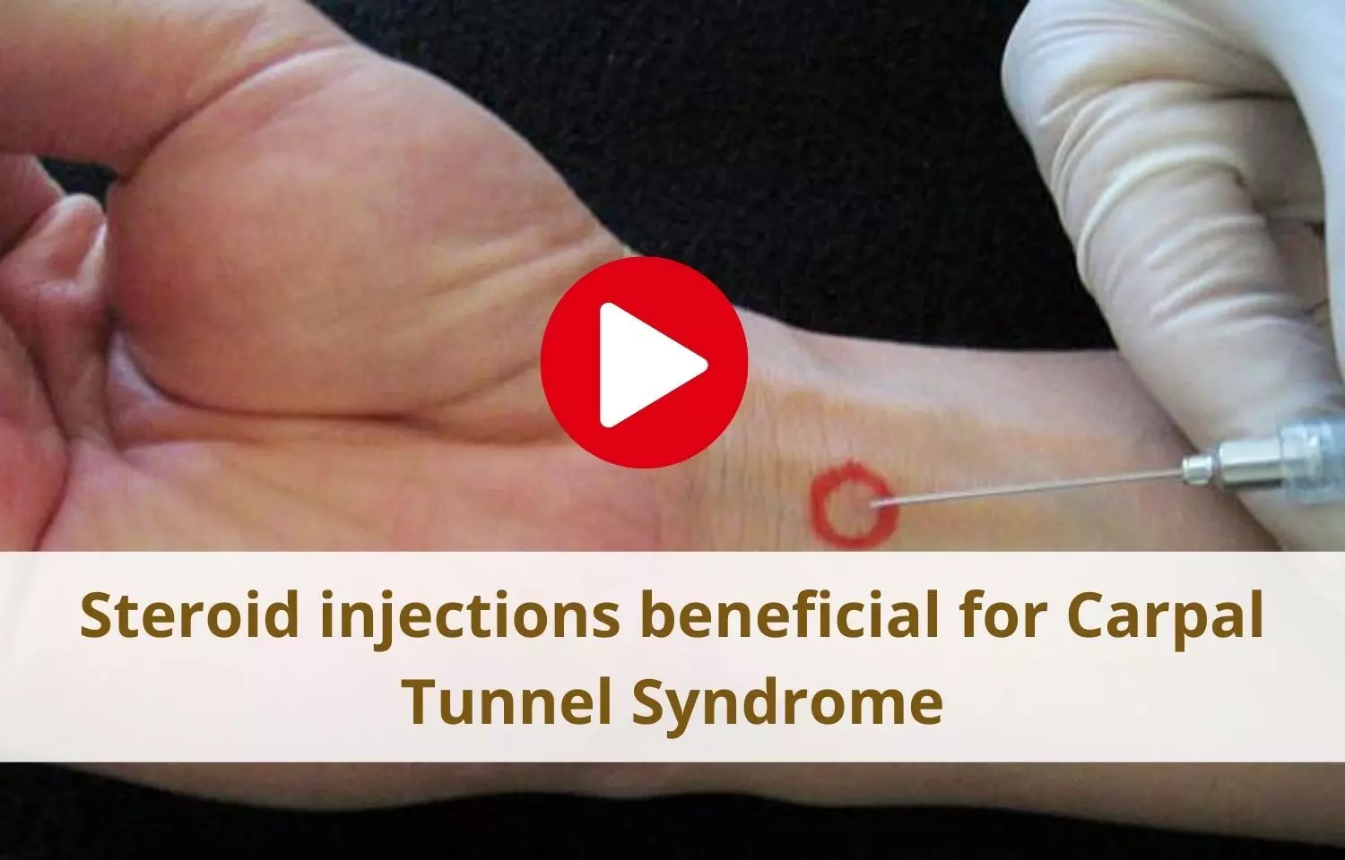 Steroid injections beneficial for Carpal Tunnel Syndrome