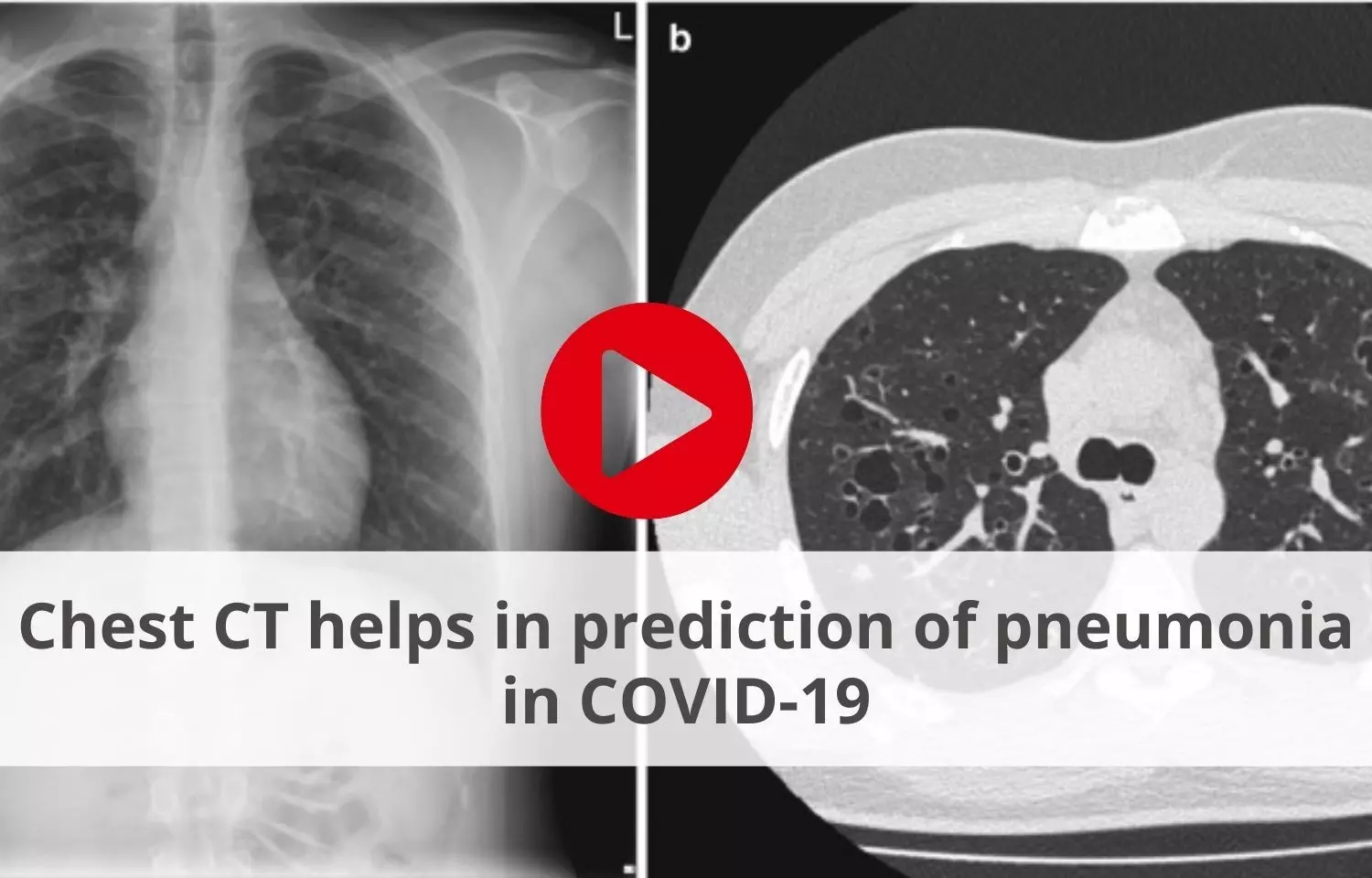 Chest CT helps in prediction of pneumonia in COVID-19