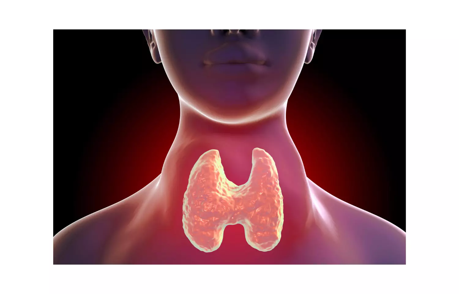 Maternal hyperthyroidism associated with cardiovascular diseases in offsprings, finds study