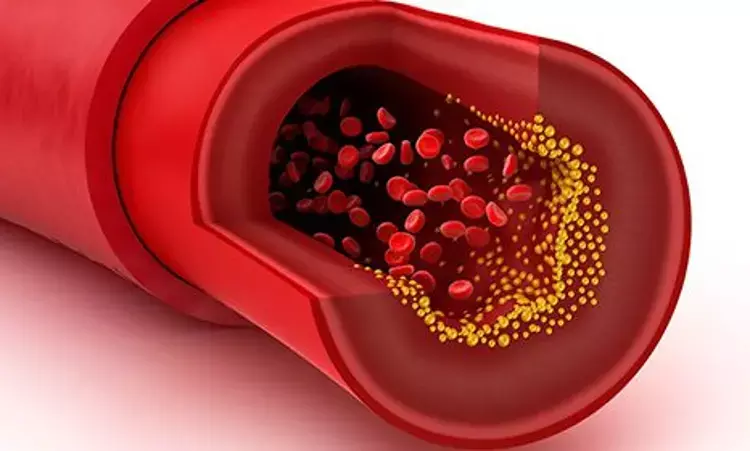 Statins reduce Atherosclerotic risk by increasing densification of Plaques: JAMA