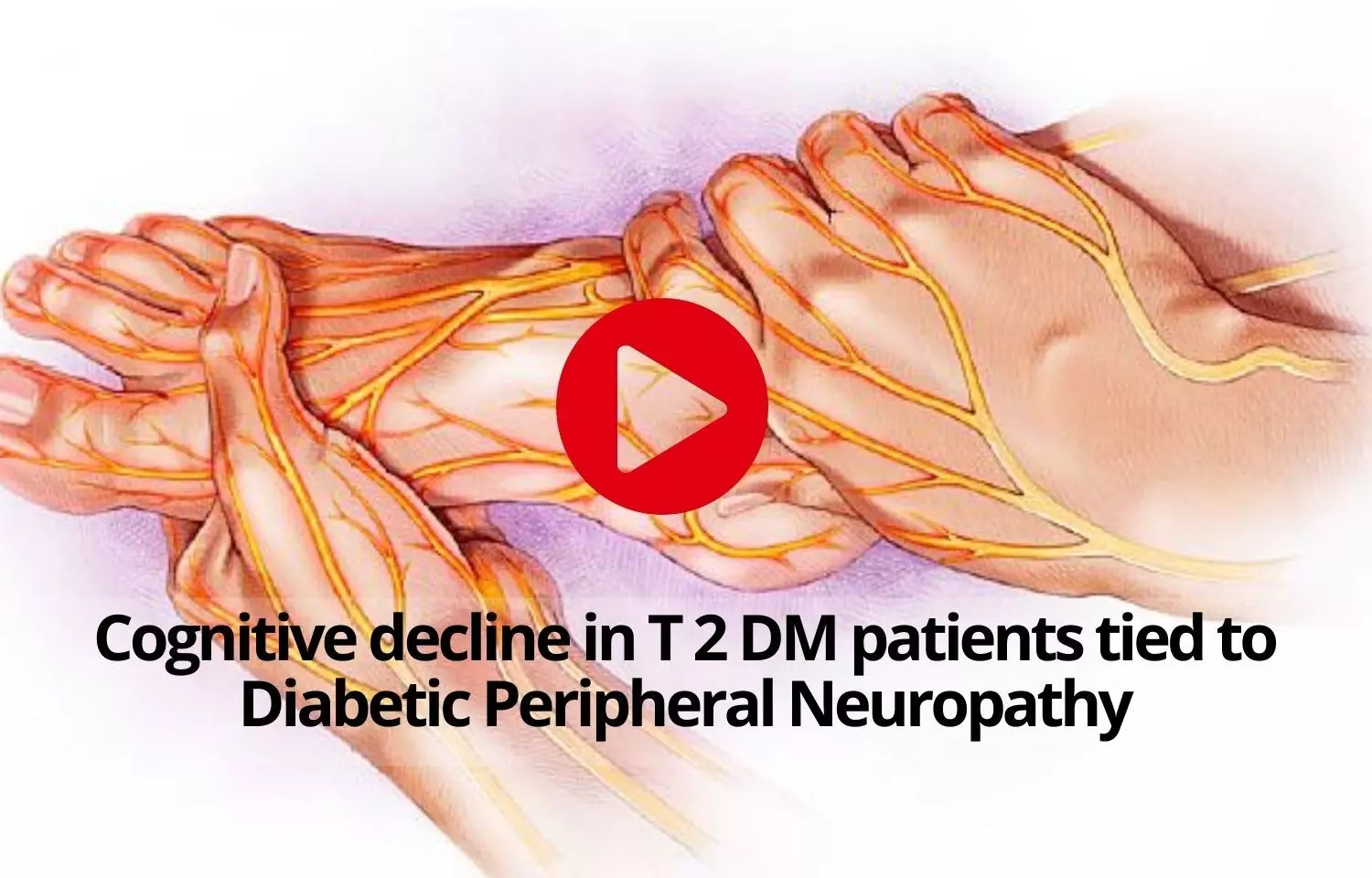 Cognitive decline in T 2 DM patients tied to Diabetic Peripheral Neuropathy
