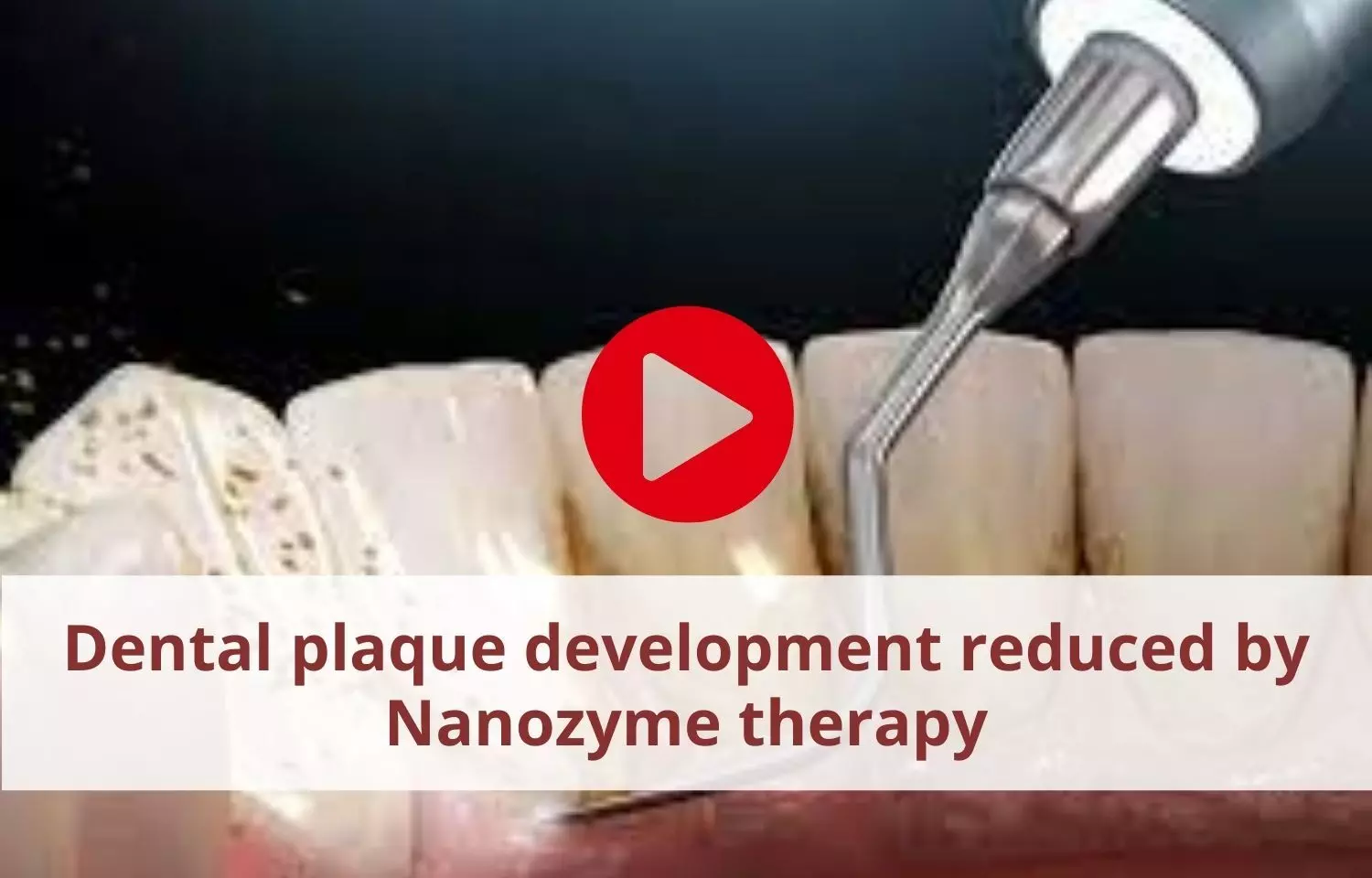 Dental plaque development reduced by Nanozyme therapy