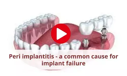 Peri implantitis - a common cause for implant failure