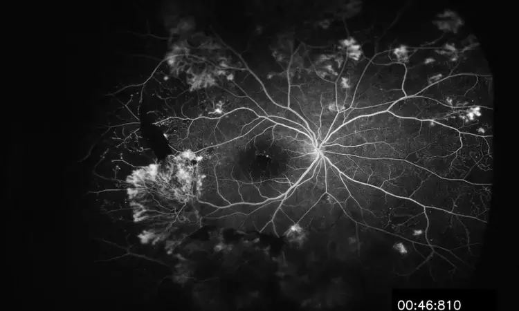 Widefield Fluorescein Angiography Helps in Diagnosing Susac Syndrome