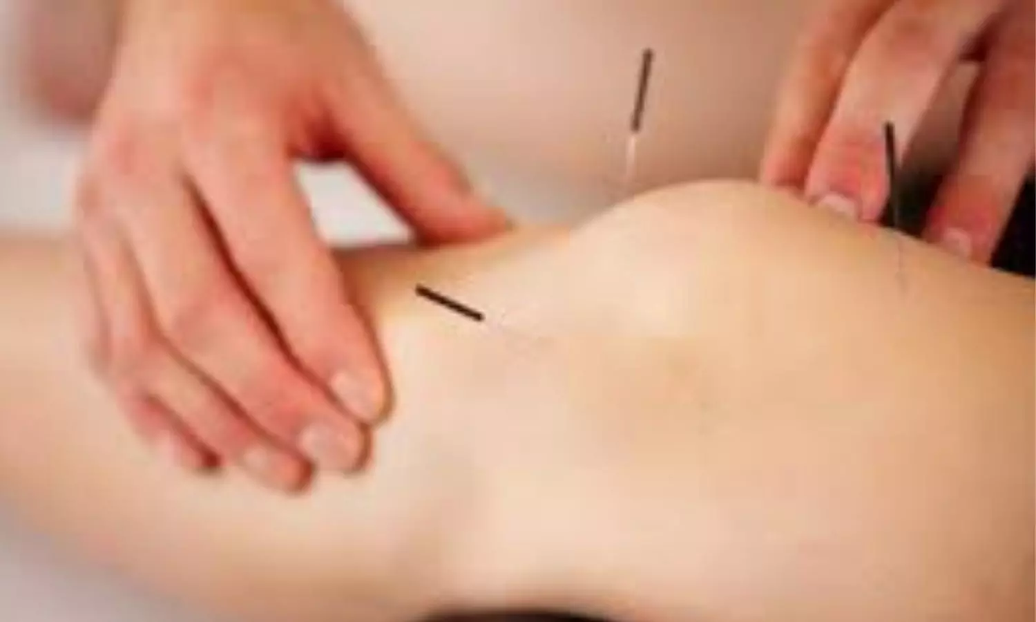 Acupuncture, an early way to manage and treat rheumatoid arthritis: Study