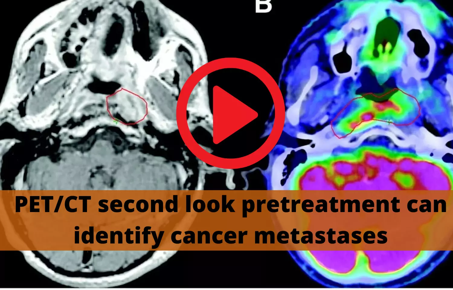 PET/CT second look pretreatment can identify cancer metastases