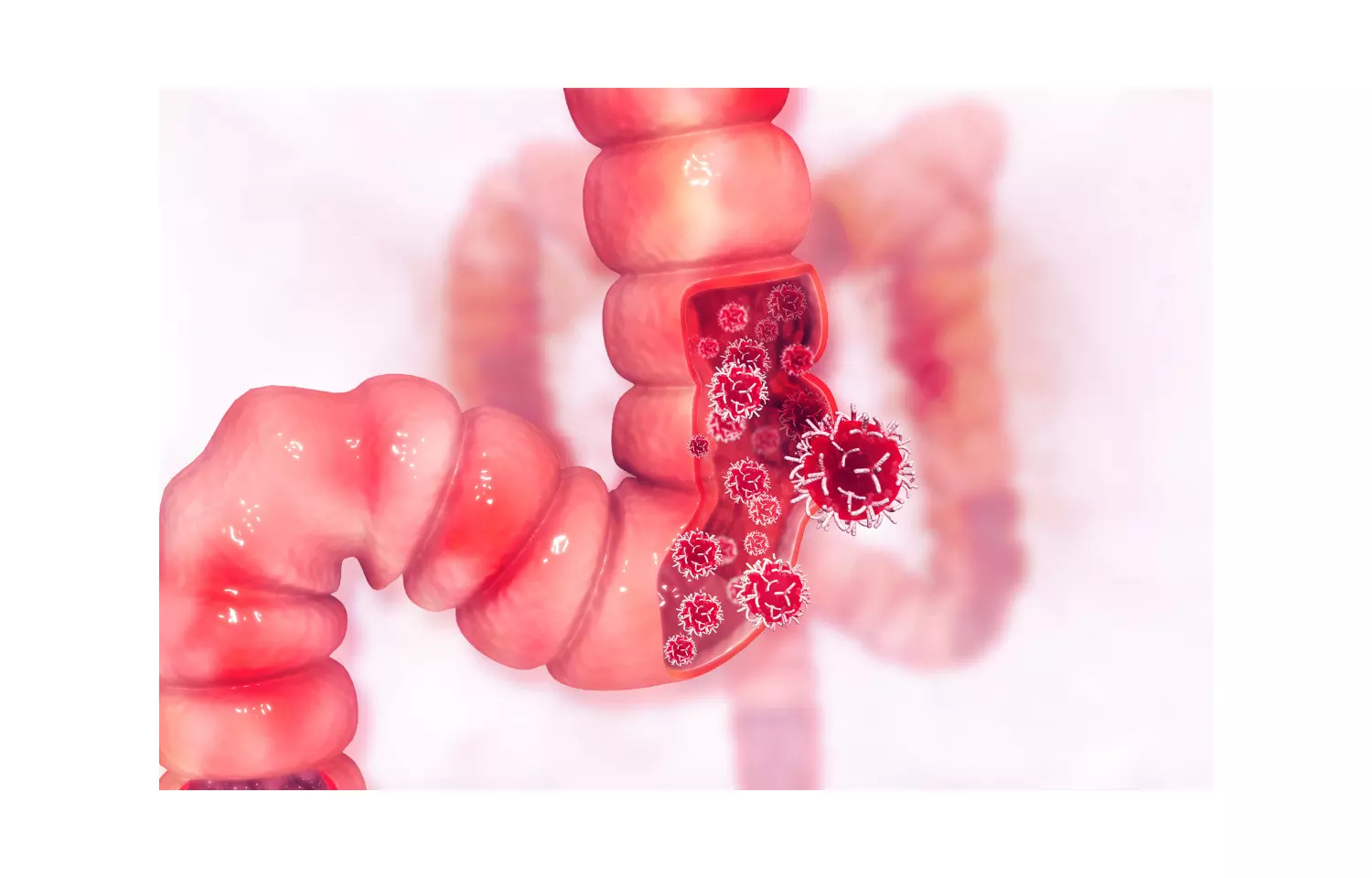 Chronic constipation not associated with colorectal cancer, study finds