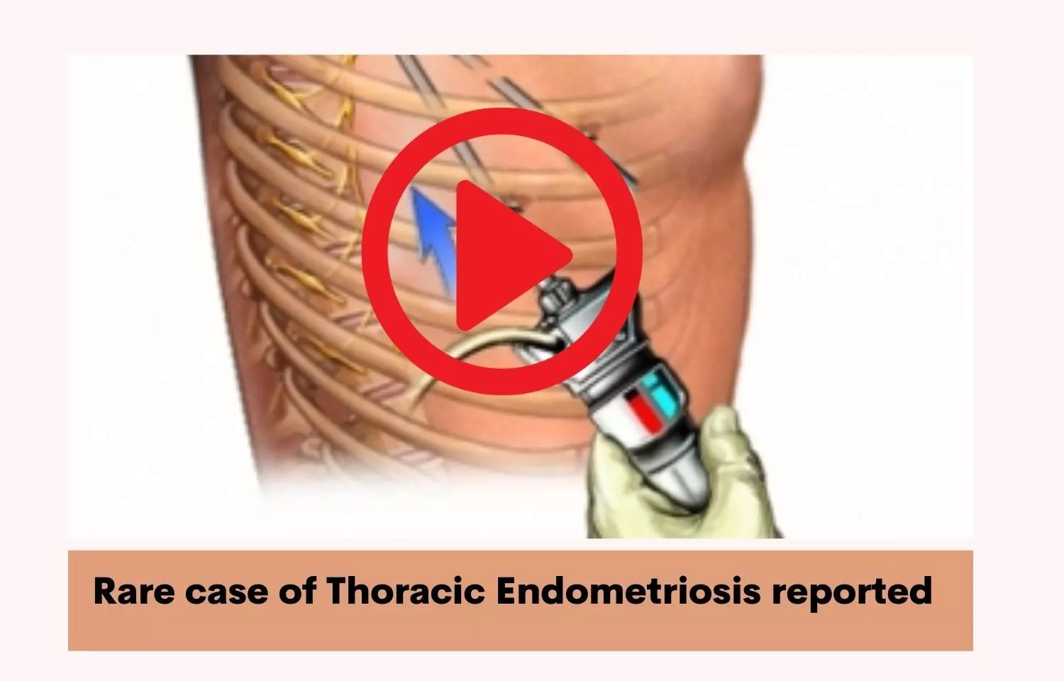 Thoracic Endometriosis rare case reported